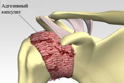 лечение капсулита