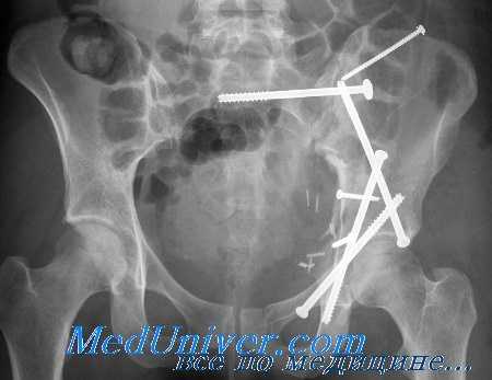 травма тазового кольца