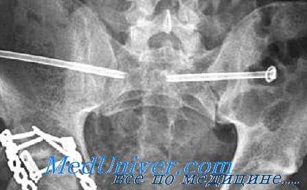 травма тазового кольца