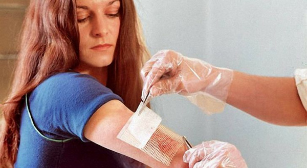 Перевязка при ожоге кожи