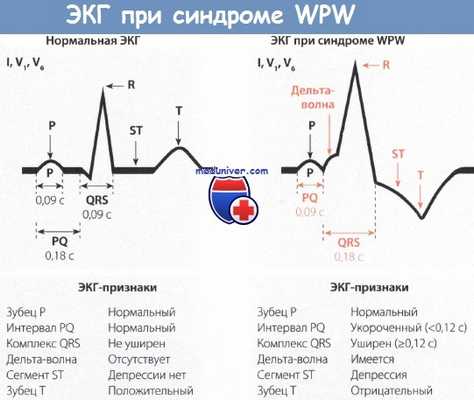 ЭКГ при синдроме Вольфа-Паркинсона-Уайта (WPW)