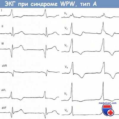 ЭКГ при синдроме Вольфа-Паркинсона-Уайта (WPW) типа А