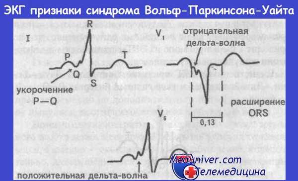 ЭКГ при синдроме Вольфа-Паркинсона-Уайта