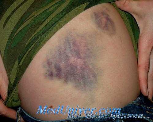 ушиб четырехглавой мышцы бедра