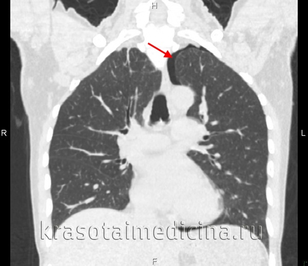 Открытый пневмоторакс