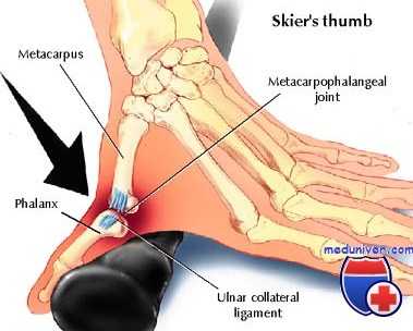 травма связок кисти