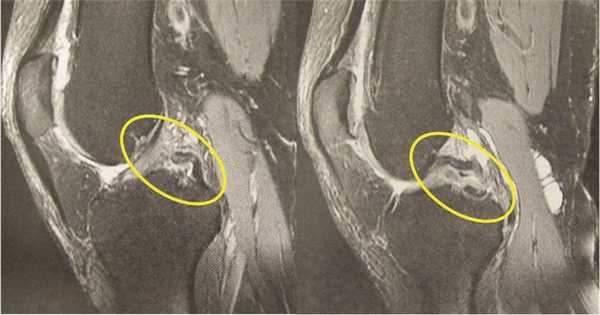Повреждение ЗКС на МРТ