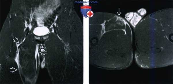 Рентгенограмма, МРТ, УЗИ при травме приводящих мышц бедра