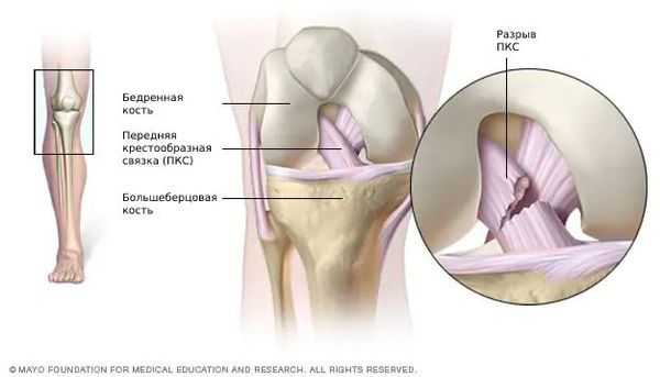 Разрыв передней крестообразной связки [13]