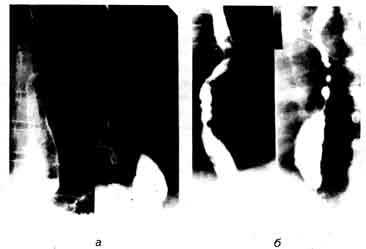 Рентгенограммы пищевода больного циррозом печени