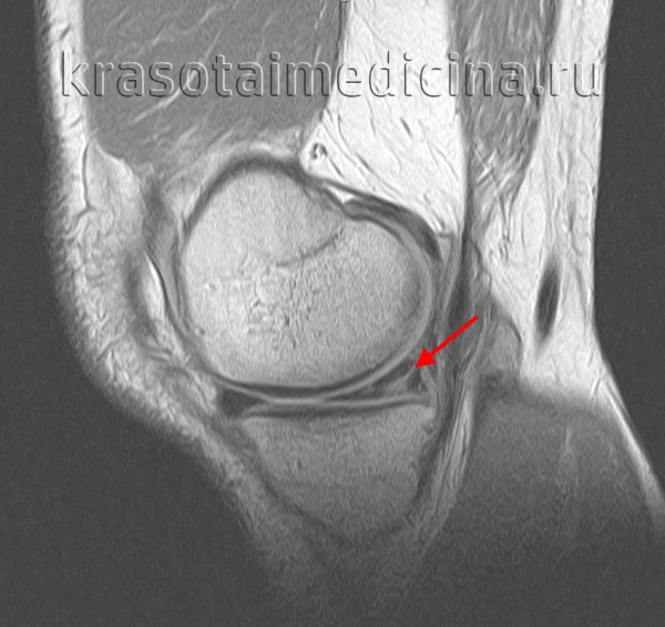 Разрыв мениска