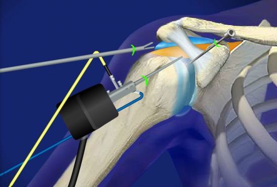 Импиджмент-синдром