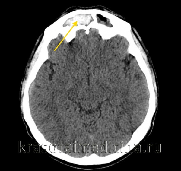 Пансинусит