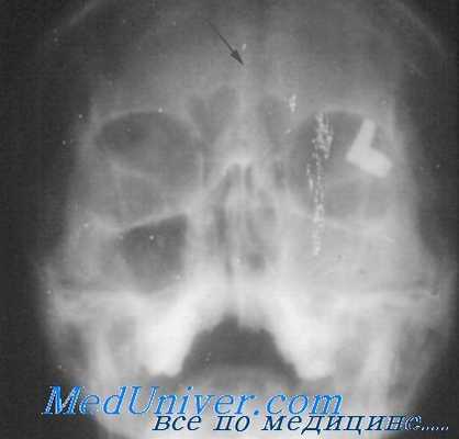 рентгенография лобных пазух носа