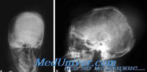 воспаление придаточной полости носа на рентгенограмме