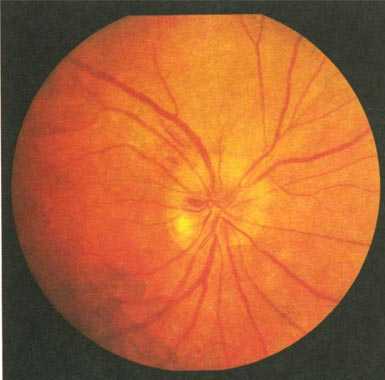 Глазные заболевания - ишемическая нейропатия