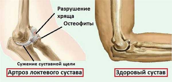 Артроз локтевого сустава
