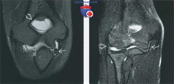 Советы по оценке МРТ артрограммы локтевого сустава