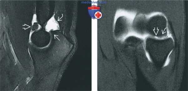 Признаки хрящевых и костно-хрящевых повреждений локтевого сустава на артрограмме