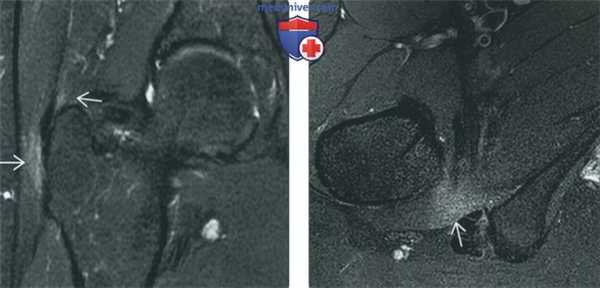 Советы по оценке МРТ артрограммы тазобедренного сустава