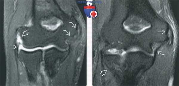 Советы по оценке МРТ артрограммы локтевого сустава