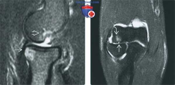 Признаки хрящевых и костно-хрящевых повреждений локтевого сустава на артрограмме