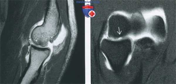 Советы по оценке МРТ артрограммы локтевого сустава