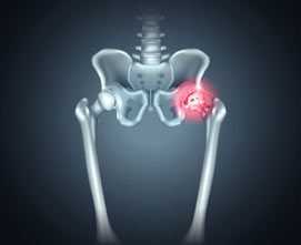 Лечение повреждений хряща тазобедренного сустава