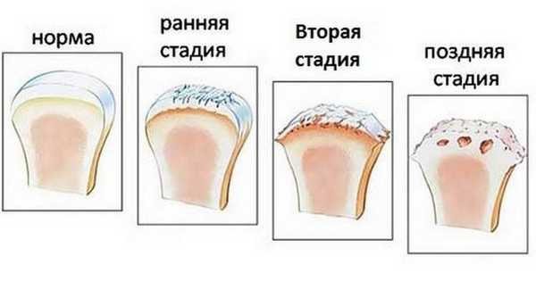 Стадии развития артроза