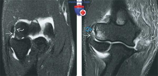 Признаки повреждения лучевой коллатеральной связки на артрограмме