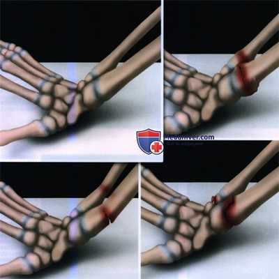 Признаки ювенильного перелома дистального конца предплечья