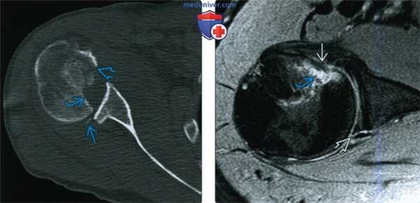 Рентгенограмма, КТ, МРТ при заднем вывихе плеча