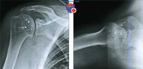 Рентгенограмма, КТ, МРТ при заднем вывихе плеча