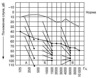 Надпороговая аудиометрия по Фаулеру-1