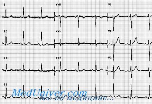 проба с физической нагрузкой