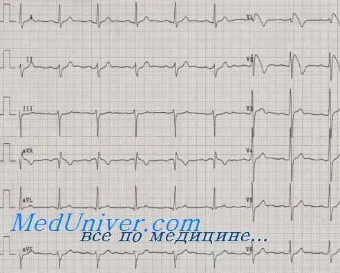 тредмил тест