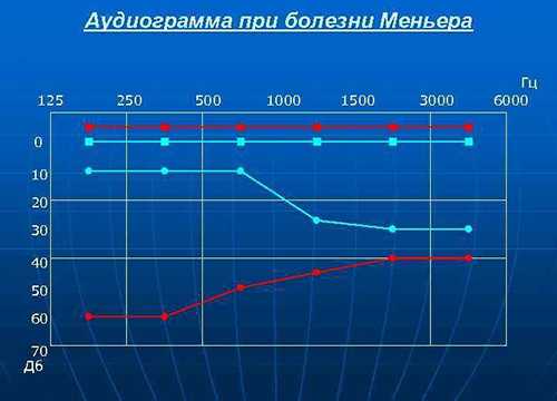 Надпороговая аудиометрия по Фаулеру-2