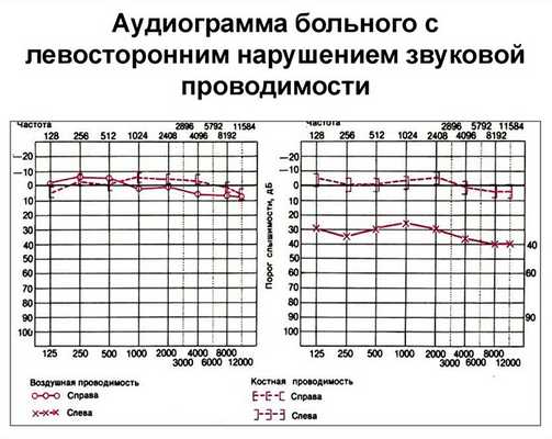 Надпороговая аудиометрия по Фаулеру-2
