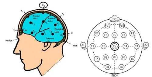 Установка электродов для записивызванных потенциалов
