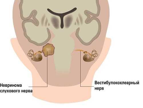 Схема невриномы слухового нерва