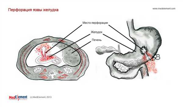 Язва желудка с прободением. Перфорация язвы желудка