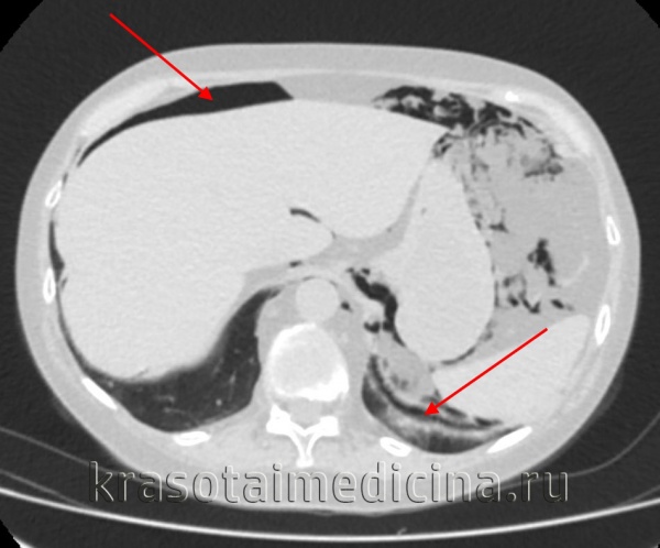 Пенетрация язвы