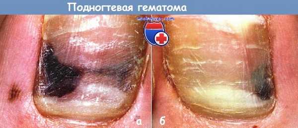 Подногтевая гематома