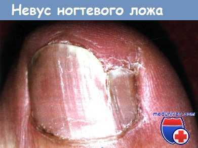 Невус ногтевого ложа