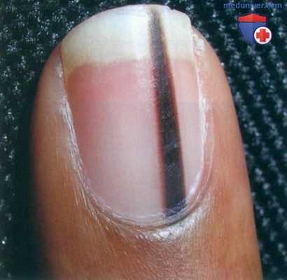 Продольная меланонихия и подногтевая меланома