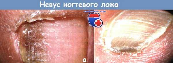 Невус ногтевого ложа