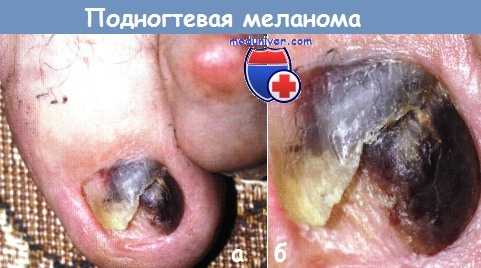 Подногтевая меланома