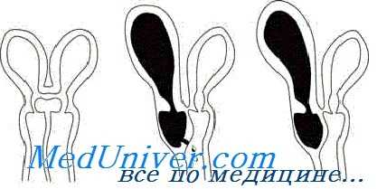 удвоение матки и влагалища