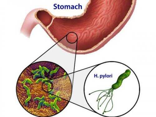 Бактерии Helicobacter Pylori в желудке