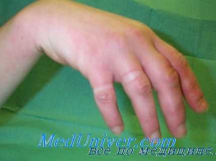 профессиональные невромиозиты